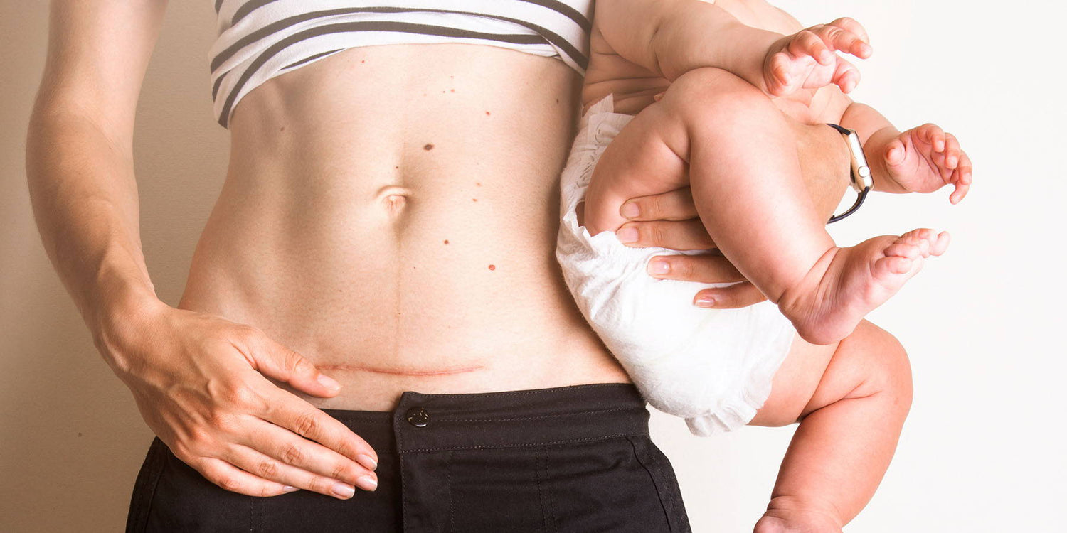 How and Why You Should Massage Your C-Section Scar